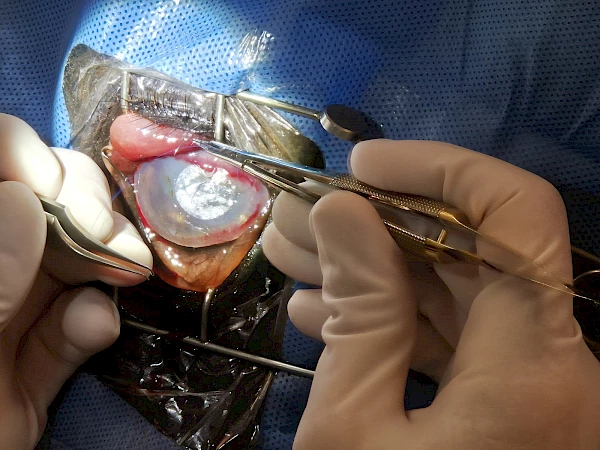 Amniontransplantat – Operation nach Hornhautinfektion