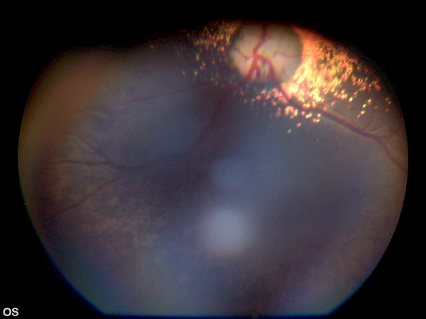 Netzhaut eines Hundes mit beginnender Degeneration (Hyperreflektive = leuchtende Areale  im Bereich des Sehnervs)
