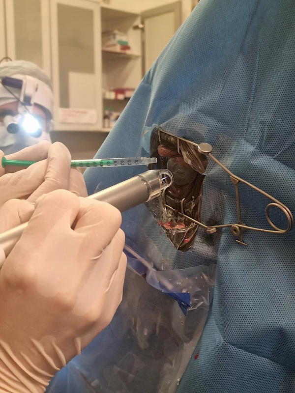 ACP – Argon Kaltplasma Therapie bei einer Keratomykose (Pilzinfektion der Hornhaut)