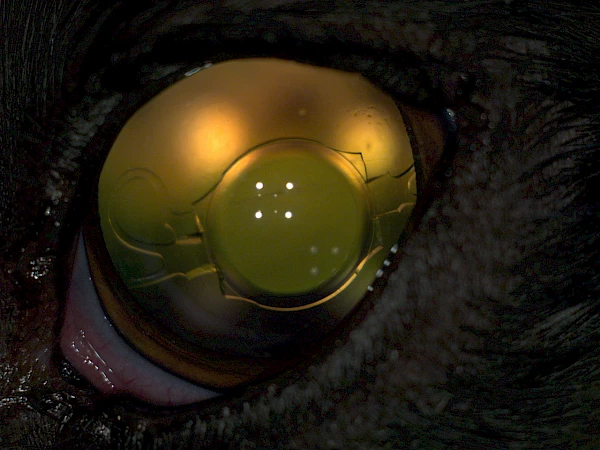 „sutured lens technique“ genähte Kunstlinse bei Luxation der Linse (nach Katarakt Operation der luxierten Linse)