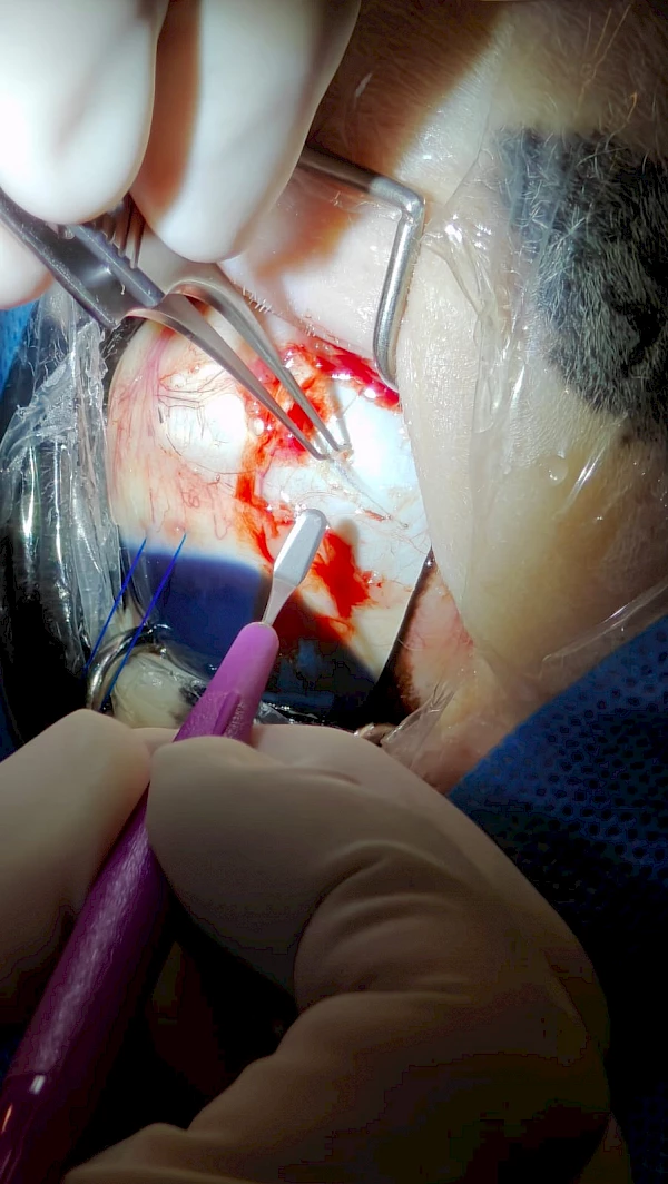 suprachoroidales Ciclosporin-Implantat (ein Implantat, das unter die Lederhaut ans Innere des Auges gebracht wird, um die Entzündungsschübe bei einer  Inneren Augenentzündung (ERU, Mondblindheit) zu kontrollieren.  Dr. Stadler operiert diese Technik im Stehen (in Europa neben Zürich Tierspital eine der wenigen Anlaufstellen, die diese Operation im Stehen anbieten).