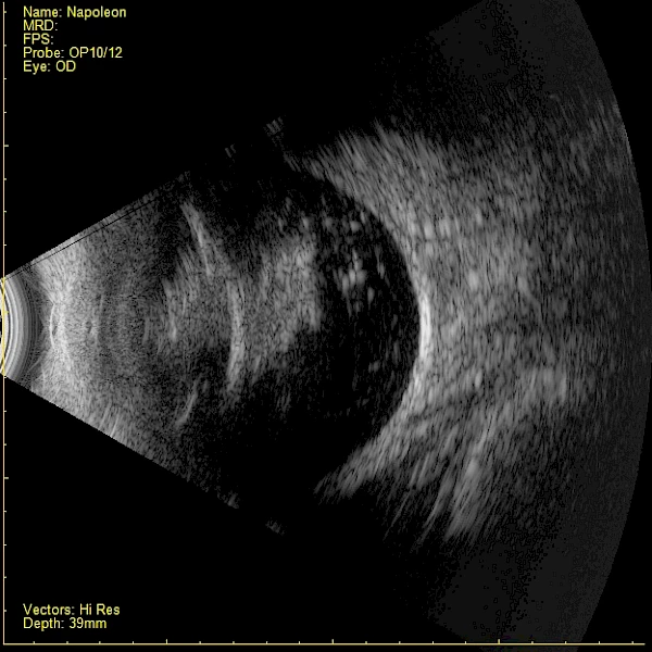 Ultraschallbild eines Hundes mit gerissener Hintere Linsenkapsel und Material im Glaskörper  und Netzhautablösung